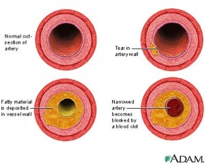 atherosclerosis-picture