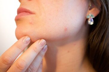 Come B. ha interrotto l’acne anche con la Nutrizione