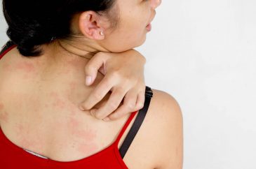 Psoriasi, disturbi metabolici e carenze di micronutrienti