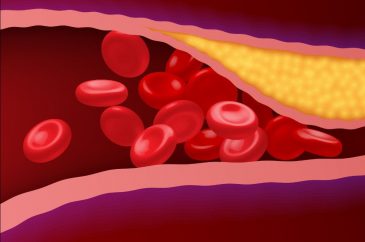 Chiunque può avere il colesterolo alto e un basso rischio cardiovascolare?
